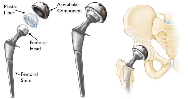 Hip-Replacement-joint-replacement-india.jpg