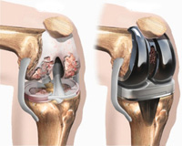 knee-replacement-1-1