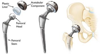 img-Hip Replacement