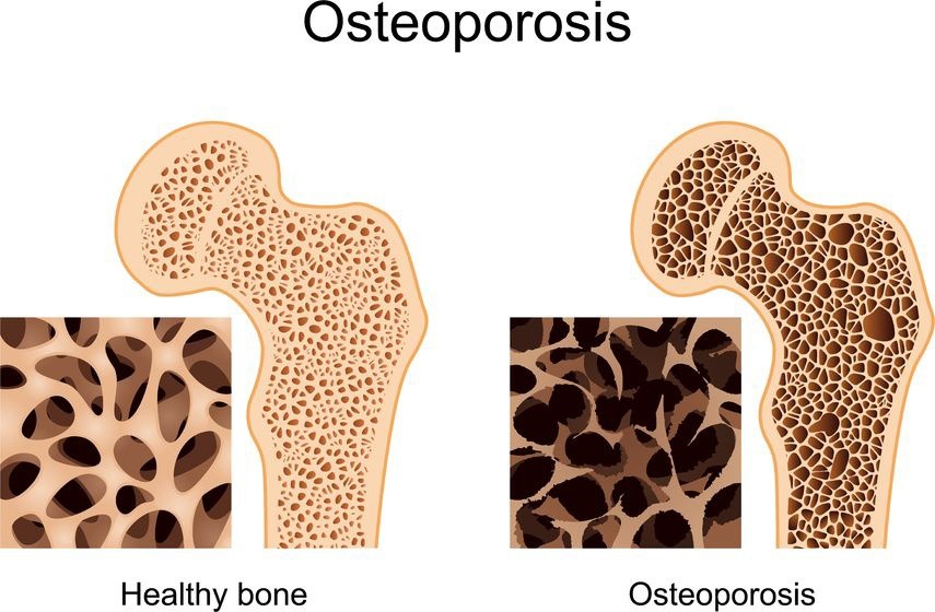 What is osteoporosis