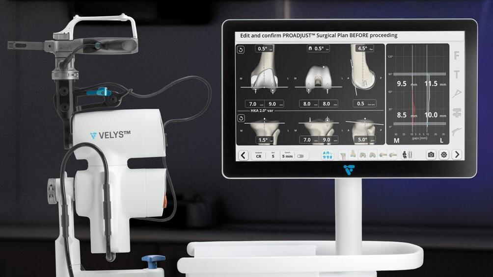 VELYS imageless robotic knee replacement planning without CT scan