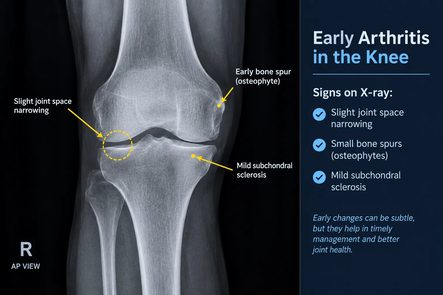 X-ray of an early-arthritic knee